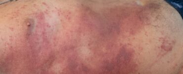 Врачи Склифа наглядно показали опасность борщевика