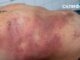 Врачи Склифа наглядно показали опасность борщевика