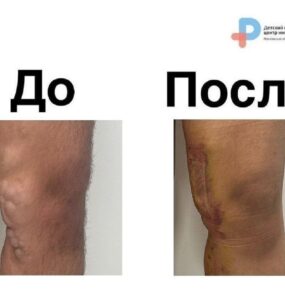Хирурги Центра Рошаля удалили у подростка огромные венозные узлы