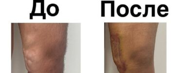 Хирурги Центра Рошаля удалили у подростка огромные венозные узлы