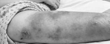 Две девочки попали в больницу в Подмосковье из-за мозолей и ссадин